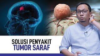 Tumor Saraf: Penyebab, Gejala, dan Cara Mengatasi  | Kata Dokter