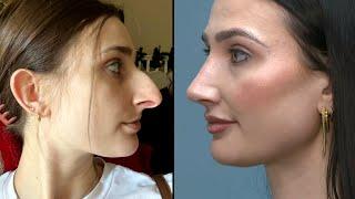 Woman Says She Saved $11,000 Over 10 Years for Nose Job