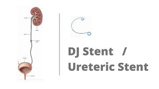 DJ stent stent / Ureteric stent