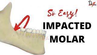 ORAL SURGERY | Impacted Third Molar Classification