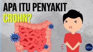 Apa itu Penyakit Crohn?