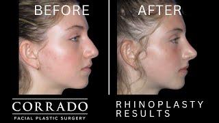 Best Rhinoplasty Results: Before and After Nose Job | Dr. Anthony Corrado