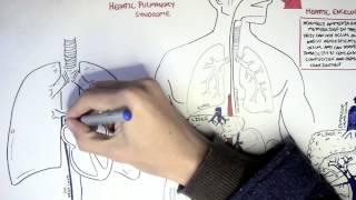 Liver Cirrhosis