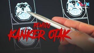 Mengenal Gejala dan Pemicu Kanker Otak