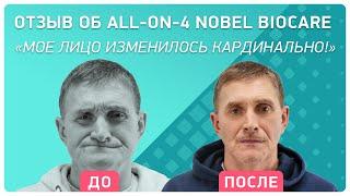 Отзыв об All-on-4 Nobel Biocare – кардинальное изменение прикуса и лица