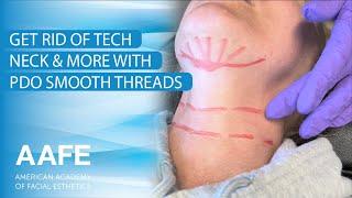 Get Rid of Tech Neck & More with PDO Smooth Threads