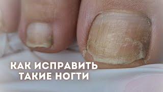 Преображение проблемных ногтей на ногах | Аппаратный педикюр | Дисковый смарт педикюр