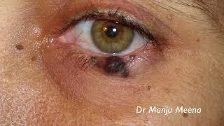 Lumps and bumps around the eyelids by .Dr Manju Meena