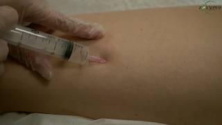 Озонотерапия тела в косметологии для похудения и борьбы с целлюлитом