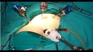 Port Position in Laparoscopy - Baseball Diamond Concept by Dr R K Mishra