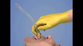 Laryngeal Mask Airway Insertion
