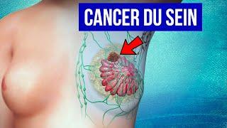 Cancer du Sein : Explications et traitements