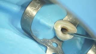 MTA apical plug(apexification)