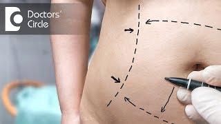 What is Tumescent Liposuction? - Dr. Ranganath