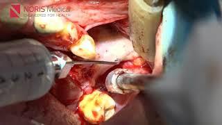 Zygomatic Extra Maxillary Guided Surgery   Noris Medical