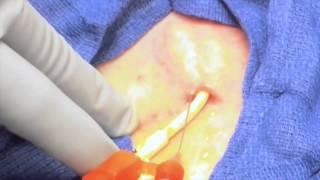 Tunneled Catheter Removal