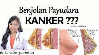 6 Jenis Benjolan Kanker Payudara dan Non Kanker | dr. Ema Surya P