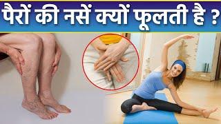 पैरों की नसें फूलने के क्या कारण है, Pair ki Nas Phulne ke karan | Boldsky *Health