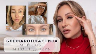 БЛЕФАРОПЛАСТИКА | ПОСМОТРИ ПРЕЖДЕ, ЧЕМ СДЕЛАТЬ!