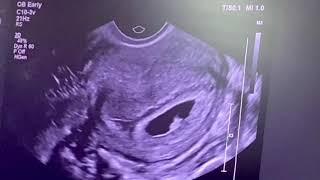 7 Weeks Ultrasound | Checking for a Heartbeat