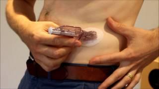 Dexcom G5 CGM Sensor Insert + Transmitter Installation