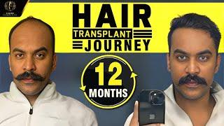 Best Hair Transplant Results: Actor Swapnil Dhondge’s Transformation Day 1 to 12 Months | Dr.Pranil