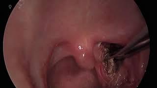 Trans-oral Styloidectomy (Eagle Syndrome)