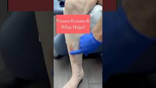 Venous Eczema & What Helps? #varicoseveins #eczema #dermaka #itchyskin #dryskin #venousdisease