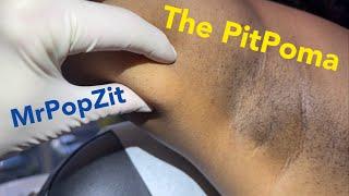 Deep Lipoma in the armpit. Actually a small pitpop with a squeeze! 2 week follow up at end of video