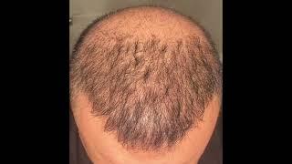 Hair Transplant result in 8 months - 4300 graft