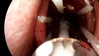 SINUVA implant for office treatment of nasal polyps