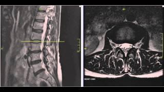 Lumbar Disc Herniation MRI Explained | Dr. Jeffrey P. Johnson | HD