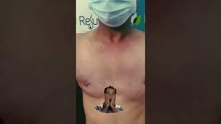 Gynecomastia Grade 2 Results Before & After | Rejuvena Cosmo Care by Dr. Deepesh Goyal