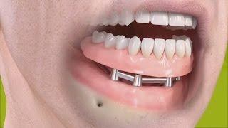 Straumann - Removable denture with bar