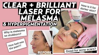 Clear + Brilliant Laser for Melasma: Dermatologist Answers FAQs with Before & After Results!