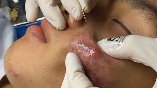 Big Pimples | Acne Treament Under The Skin #027