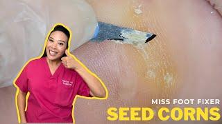 Super Painful Deep Seeded Corn Removal: Quick & Pain-Free Methods | Miss Foot Fixer