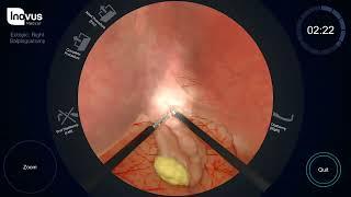 Ectopic Salpingectomy approach