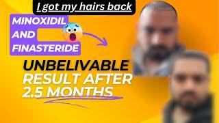 I got my hairs back - Minoxidil and finasteride results after 2.5 Months #minoxidil #finasteride