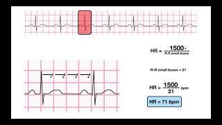 Determine HR from a Regular-Rhythm EKG | 1500- & 300-methods