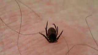 Tracking ticks: Is that a tick bite?