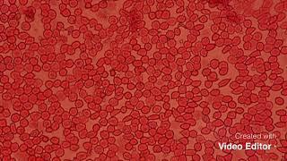 Overview of Fetomaternal hemorrhage Test (Kleihauer Bekte) acid elution