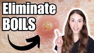 How To Get Rid Of Boils | Dermatologist Tips