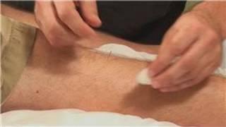 Acupuncture & Health : Acupuncture for Cholesterol