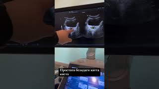 Простата бези киста #doctor #prostata #urologysurgery #andrology