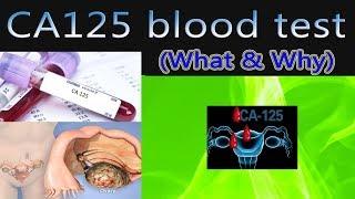 CA 125 blood test ovarian cyst -  tumour marker (What & Why)