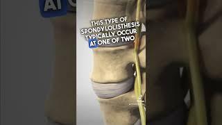 What is Spondylolisthesis ? #spondylolisthesis #sciatica #backpain #l4l5 #discbulges #backinjury