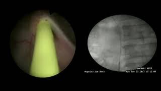 Blueneem's Dalela Triple J Ureteral Stent - Procedural Video By Dr Diwakar Dalela