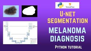 Medical Melanoma Detection |  TensorFlow U-Net Tutorial using Unet