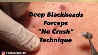 Blackhead REVENGE Part 1 of 3 (part 2  will be published 6/15/19 subscribe to see it)